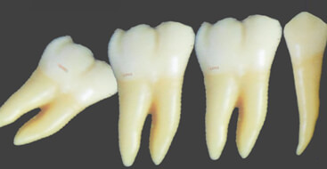 El Tercer molar mandibular: "Método de predicción"